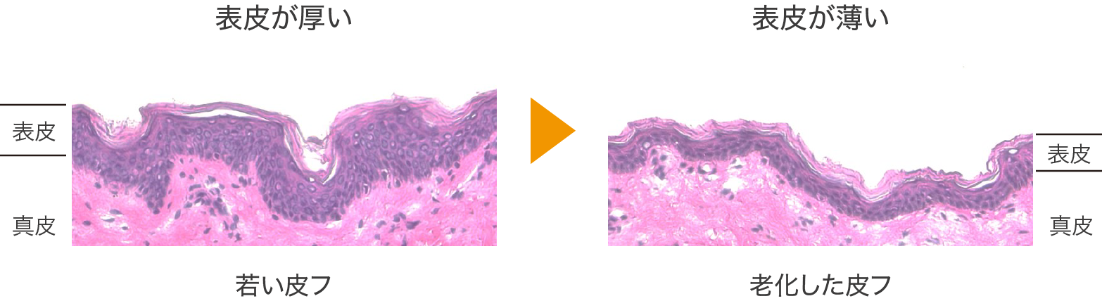表皮の菲薄化