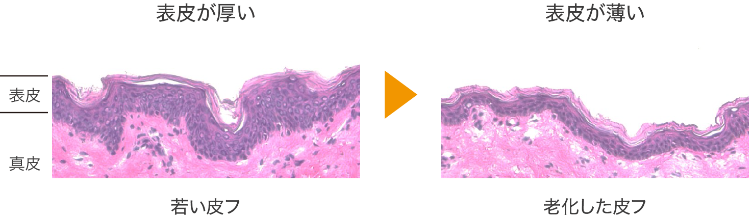 表皮の菲薄化